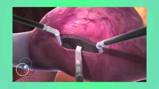 Atrioventricular Septal Defects Ami Bhatt MD [upl. by Codel]