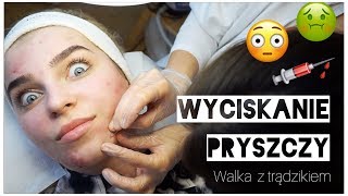 WYCISKANIE PRYSZCZY 😱💉 walka z trądzikiem 💪 [upl. by Laersi756]