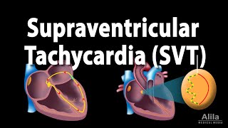 Supraventricular Tachycardia SVT PSVT Animation [upl. by Atokad]