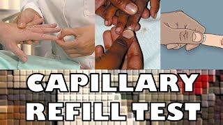 CAPILLARY REFILL TEST  FAST amp SIMPLE  Ohio University  Human Anatomy amp Physiology [upl. by Mintz956]