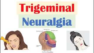 Trigeminal Neuralgia “Severe Facial Pain” Causes Pathophysiology Symptoms Diagnosis Treatment [upl. by Scotti]