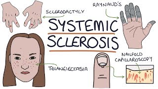 Systemic Sclerosis and Scleroderma Visual Explanation for Students [upl. by Isyed]